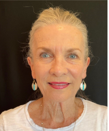 Refreshed skin after treatment at Lake and Lumen