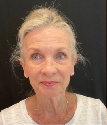 Tired skin before treatment at Lake and Lumen